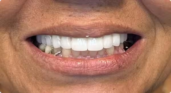 The image shows a close-up of a person's smiling face with teeth, featuring a wide smile and visible dental implants.