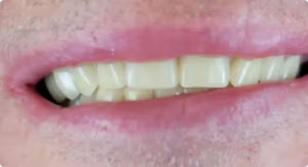An image depicts a close-up view of a person's mouth with a wide smile, showcasing teeth and lips against a neutral background.
