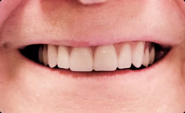 The image shows a close-up view of a person s smiling mouth with white teeth, set against a neutral background.