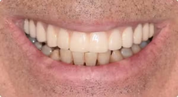 The image shows a close-up of a person s smiling face with teeth, which appears to be a composite or artificial tooth structure.