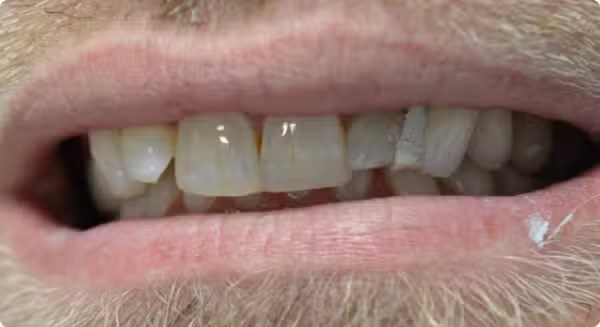 The image shows a close-up of a person s mouth with teeth, displaying an unkempt appearance with visible stubble and a beard.