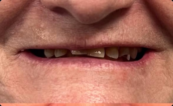 The image shows a close-up of an elderly individual with a smile revealing teeth with visible wear and possibly some missing, against a blurred background that suggests a person s face.