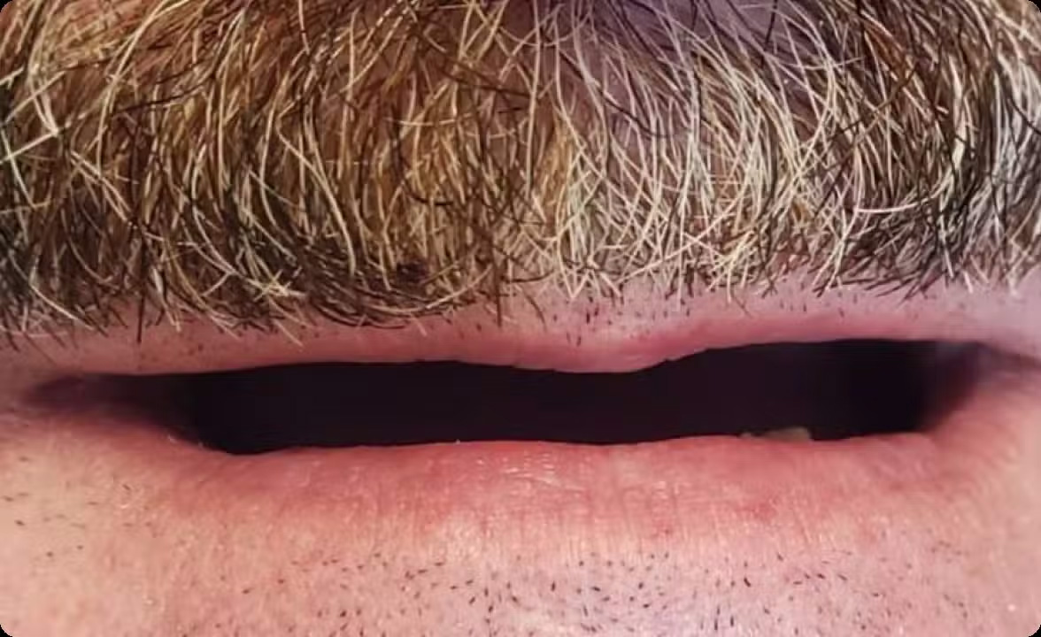 The image shows a close-up view of a person s face with a prominent mustache and beard, focusing on the mouth area where the upper lip hair appears to be missing or trimmed very short.