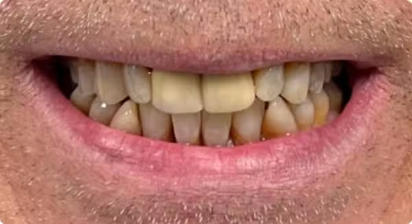 The image shows a close-up of a person s teeth with a visible yellow tint, likely due to staining or discoloration.