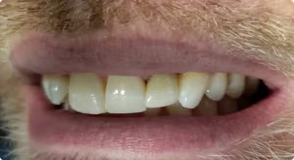 The image shows a close-up of a person s face with a focus on their teeth, which are prominently featured. The individual appears to be smiling and has facial hair.