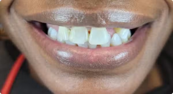 The image shows a close-up of a person with an open mouth displaying teeth, against a blurred background.