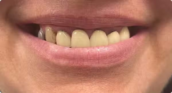 The image shows a close-up of a person s smiling face with visible teeth and lips, set against a blurred background that appears to be indoors.