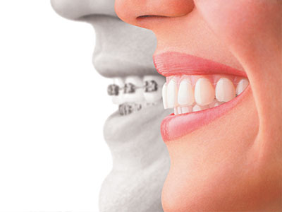 The image shows a composite photo of a smiling human face with an overlaid illustration of a mouthpiece, suggesting dental care or orthodontic treatment.