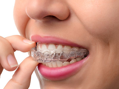 The image shows a person with a clear braces appliance in their mouth, holding a finger up to their lips, seemingly examining or adjusting the braces.