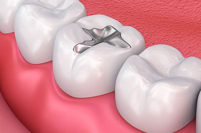 The image displays a close-up view of a dental implant integrated into a human tooth, set against a background of pink gum tissue.