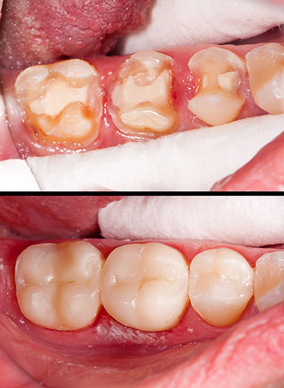 The image shows a close-up view of a person s teeth with visible decay and staining, emphasizing dental care and oral hygiene issues.