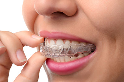 This image shows a person s hand holding up a clear plastic aligner with a toothpaste-like substance on it, set against a white background.