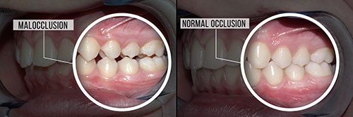 The image shows two photographs of a person s teeth with annotations indicating  malocclusion  in one photo, which suggests improper alignment of the teeth.