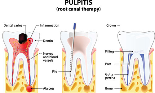 The image shows a medical illustration of a tooth with pulpitis, labeled with annotations explaining the different parts involved in the condition.