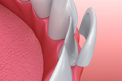 The image shows a close-up view of a dental implant with a screwed into a pink oral tissue background, likely for illustrative purposes.