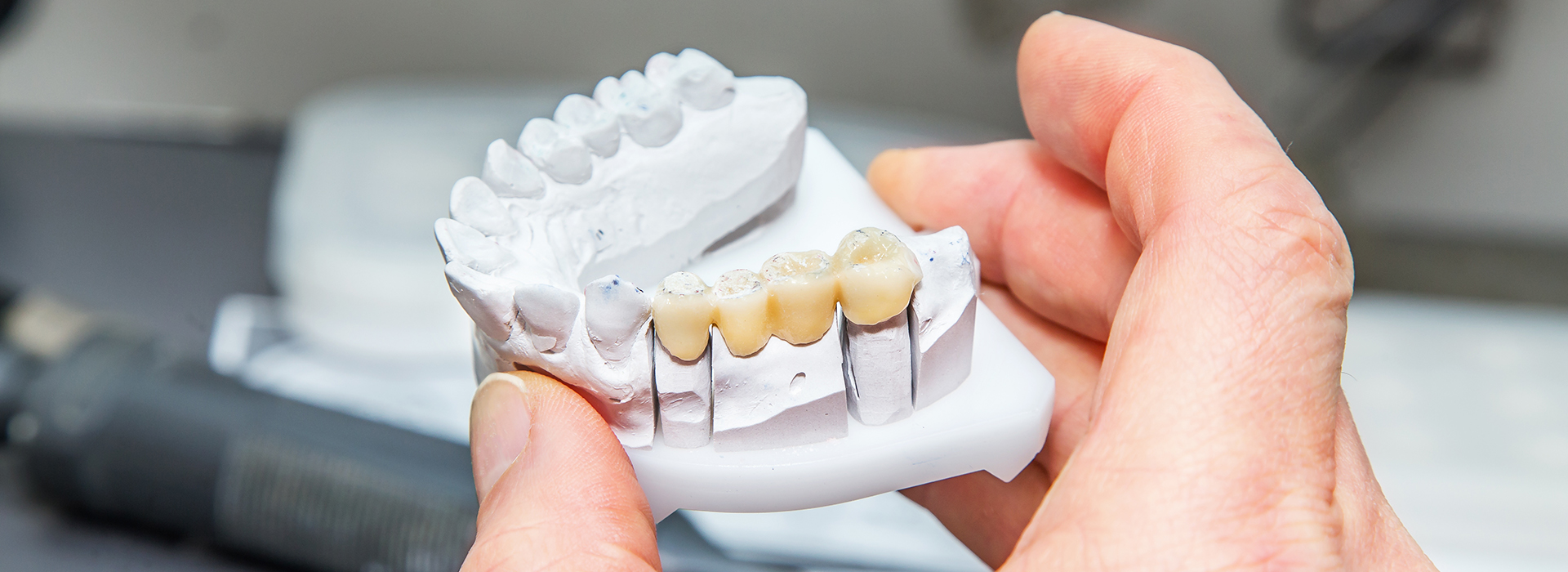 A person s hand holding a clear plastic dental model with multiple teeth missing.