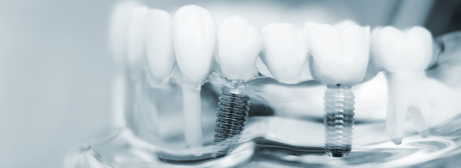 The image shows a close-up view of multiple dental implants with visible screws, set against a blurred background.