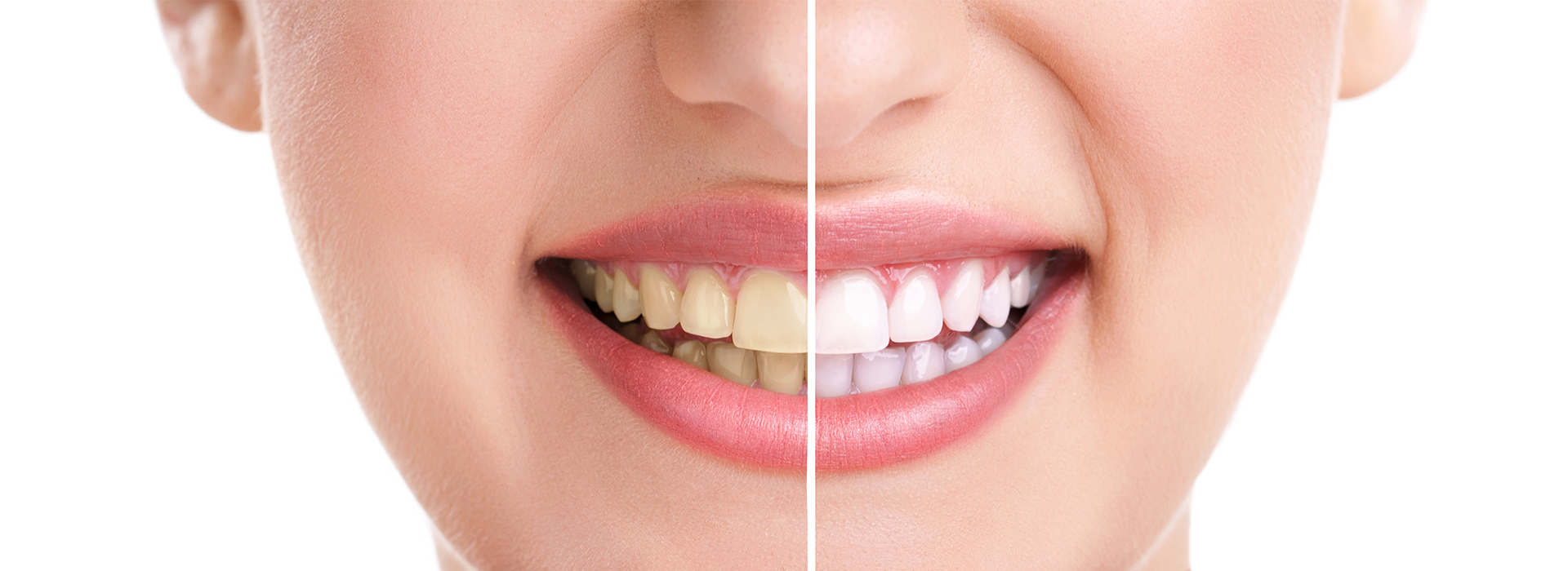 The image shows a smiling woman with teeth before and after dental treatment, highlighting the results of cosmetic dentistry.